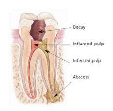 Kay Dental Tucson Root Canal Therapy