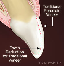 Kay Dental Veneer